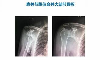 尾椎脱位手法复位视频,尾椎脱位手法复位操作步骤详解