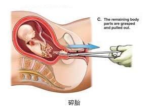 女人做人流视频